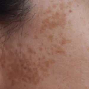 Postinflamatorna hiperpigmentacija